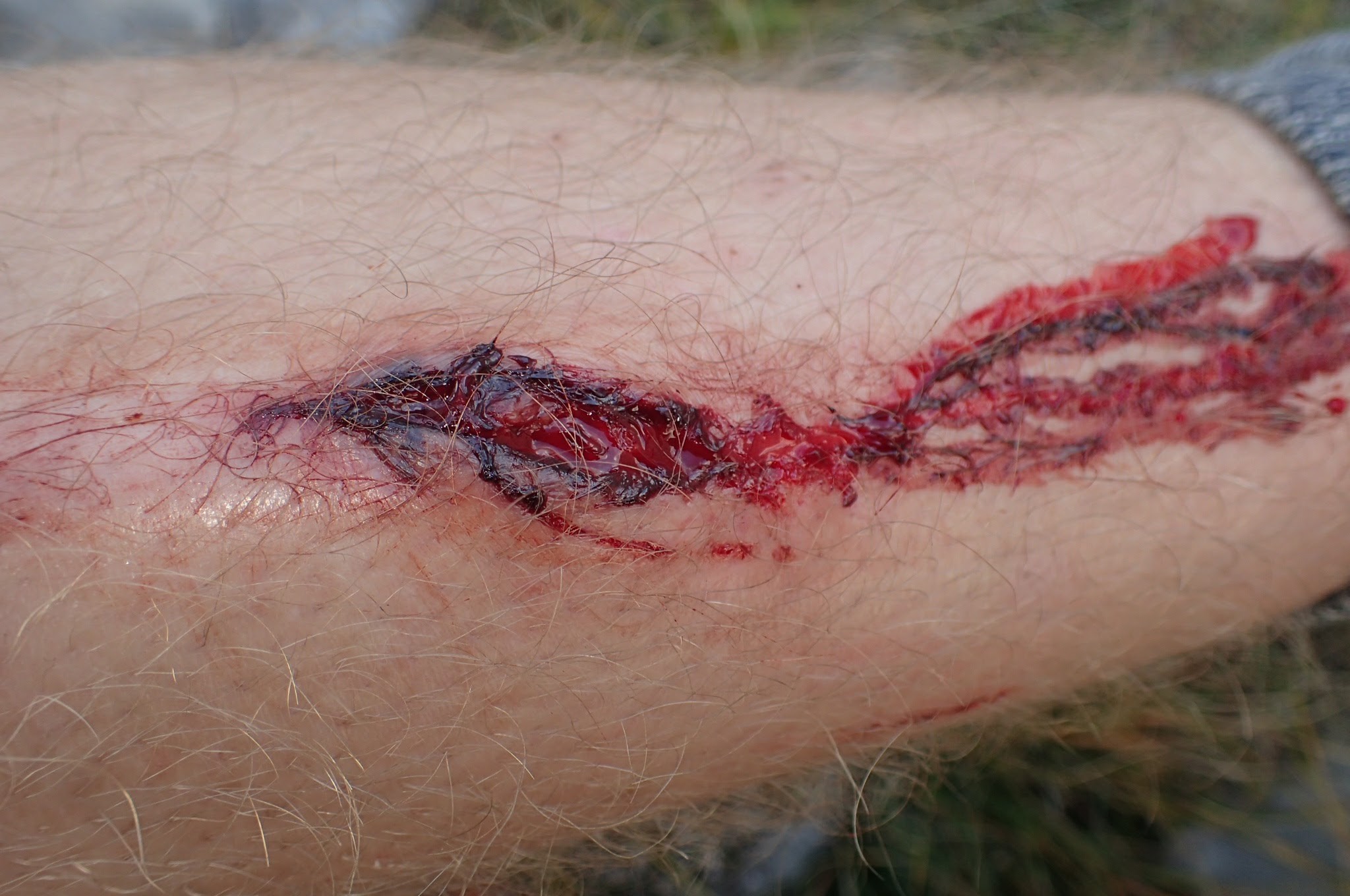 leg-wound